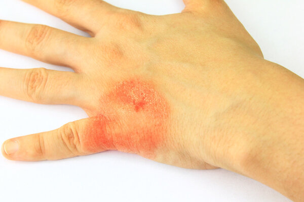 应对皮肤瘙痒要从饮食入手