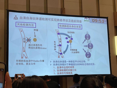 胡海：自身抗体能对肺癌进行准确的诊和筛