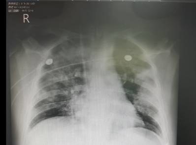 把饮料当水喝后遗症：患糖尿病酮症酸