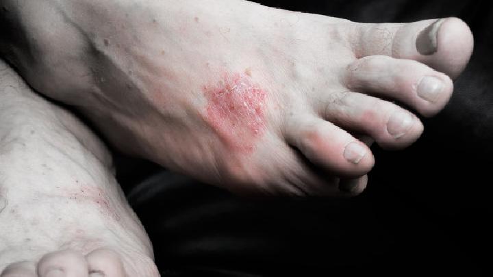 牛皮癣可以治愈——无稽之谈!