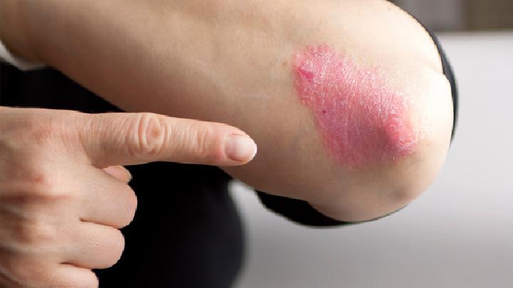 浅析中医治疗牛皮癣