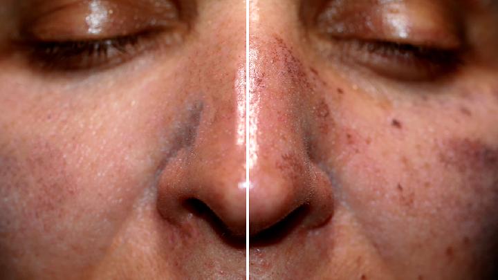 引发痤疮的因素主要都有什么呢?