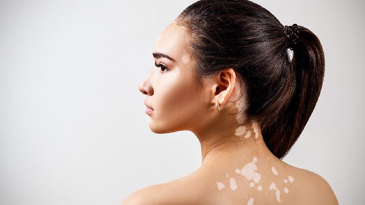 初期白癜风的治疗方法有什么