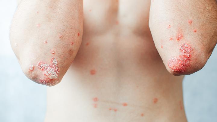 四种类型牛皮癣的症状