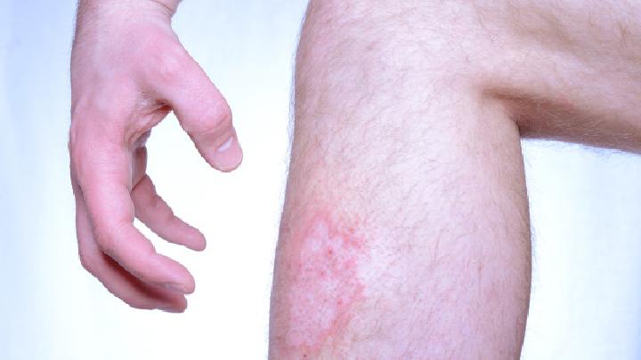 哪些表现可以被诊断为牛皮癣