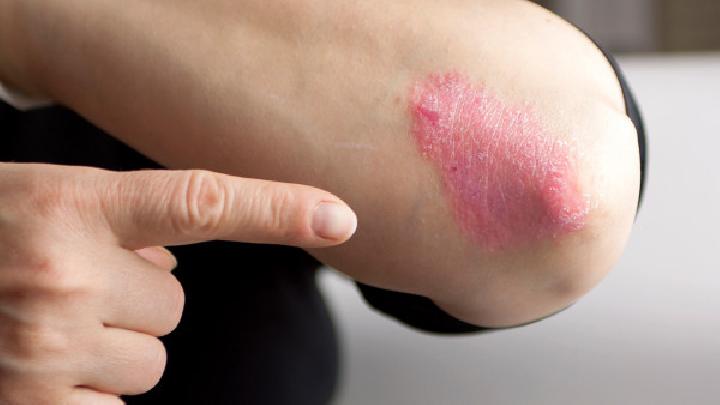 专家详谈牛皮癣会遗传吗