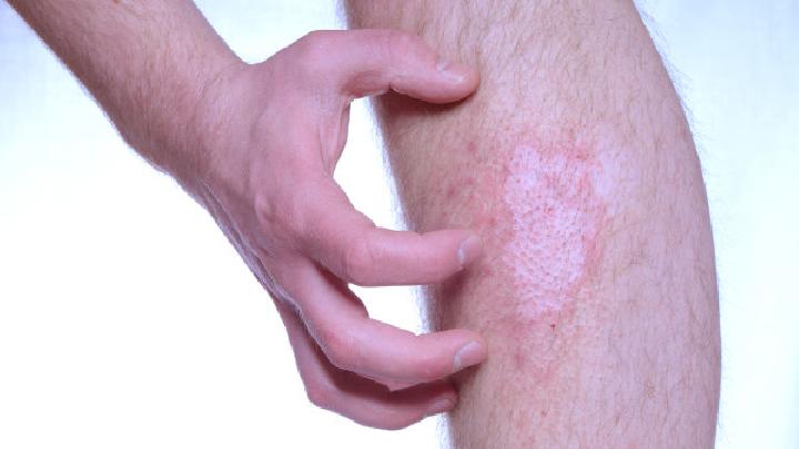 帮助大家有效地治疗牛皮癣