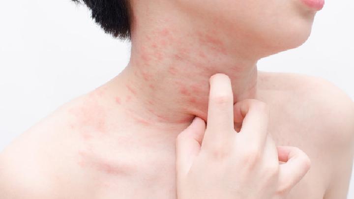专家解读诱发湿疹的主要原因