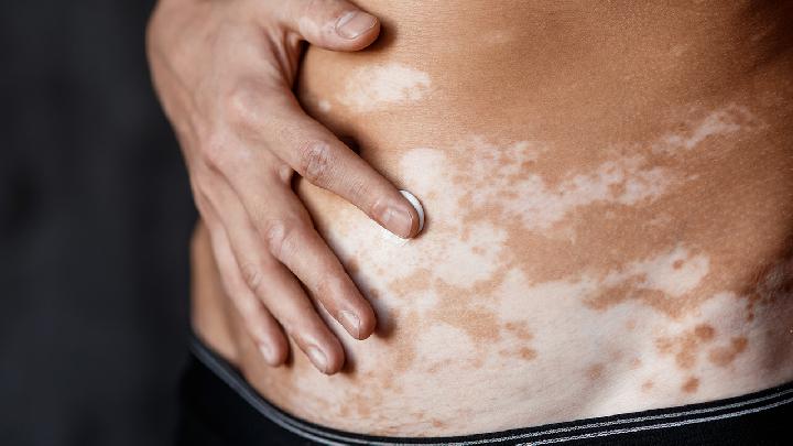 主要引起白癜风的原因有哪些