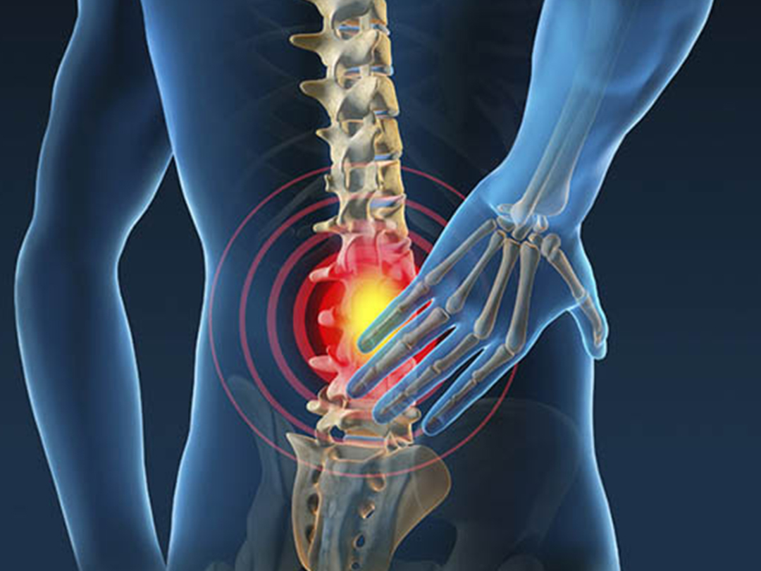 腰椎间盘突出症