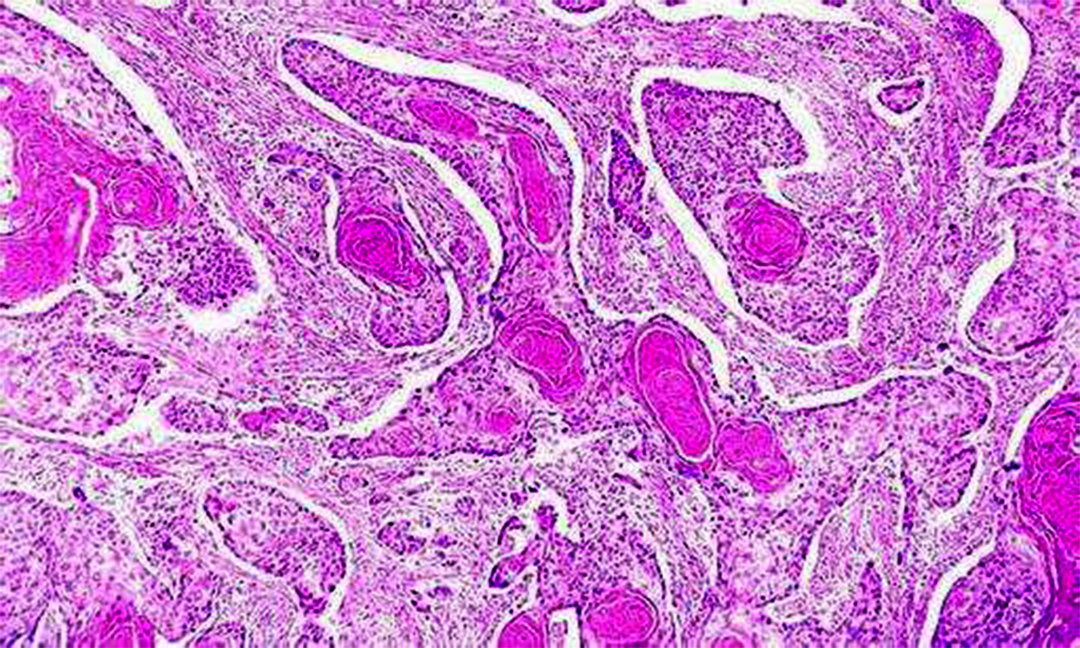 外阴鳞状上皮细胞增生