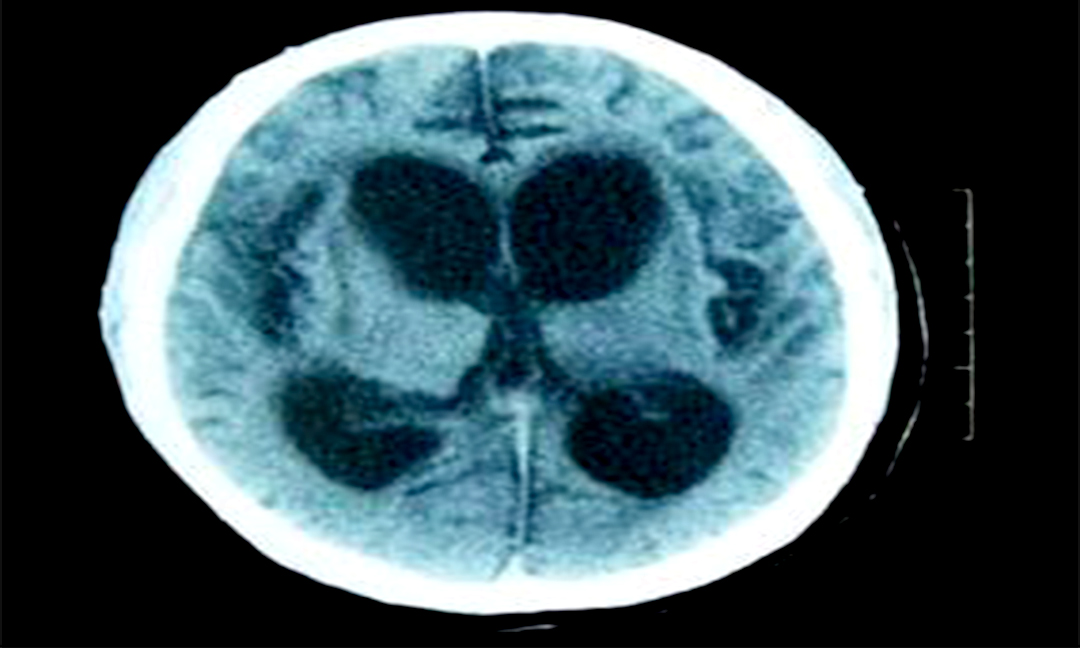 脊髓小脑性共济失调