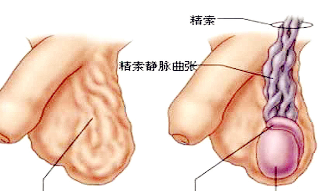 精索静脉曲张